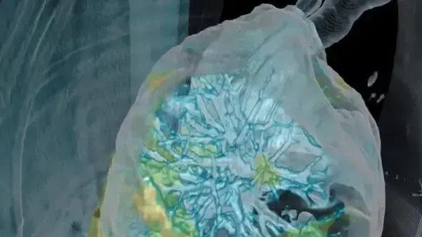 הדמיה של נזק שנגרם לריאות של חולה קורונה, שנעשתה בטכנולוגיה ישראלית של חברת Surgical Theater