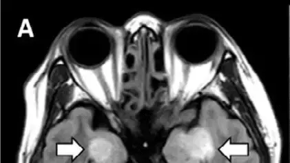 צילום מתוך סריקת MRI שנערכה לחולת קורונה בת 58 בארה"ב שפיתחה סיבוך מוחי נדיר צילום מתוך סריקת MRI שנערכה לחולת קורונה בת 58 בארה"ב שפיתחה סיבוך מוחי נדיר