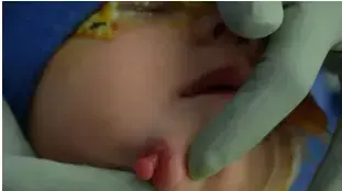 תינוקת שנולדה בארה"ב עם פה נוסף במהלך הניתוח לתיקון המום הנדיר בפניה תינוקת שנולדה בארה"ב עם פה נוסף במהלך הניתוח לתיקון המום הנדיר בפניה