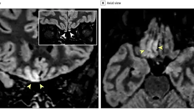 סריקות MRI של מוחה של צעירה מאיטליה שמראות כיצד נגיף הקורונה שינה את מבנה המוח שלה וגרם לאובדן חוש הריח סריקות MRI של מוחה של צעירה מאיטליה שמראות כיצד נגיף הקורונה שינה את מבנה המוח שלה וגרם לאובדן חוש הריח