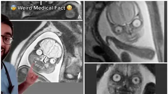 MRI של עוברים
