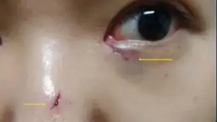 אישה מטייוואן שנתקעו לה חתיכות של צ'ופסטיקס באף בעקבות ריב אלים עם אחותה אישה מטייוואן שנתקעו לה חתיכות של צ'ופסטיקס באף בעקבות ריב אלים עם אחותה
