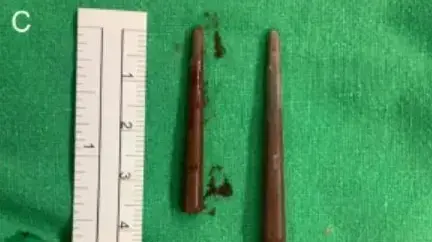 חתיכות של צ'ופסטיקס שהוצאו מאפה של אישה בטייוואן בעקבות ריב אלים עם אחותה