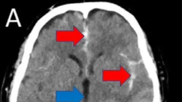 בבדיקת CT (בתמונה) נראה כי מוחו של האיש מדמם. החומר הלבן שמסומן על ידי החצים האדומים הוא דם טרי שלא אמור להיות שפ. את המרחבים האלה צריך למלא נוזל מוחי, שנראה כמו אזור המסומן על ידי החץ הכחול