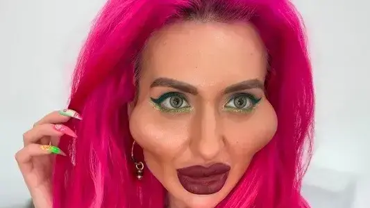 האישה עם הלחיים הגדולות בעולם
