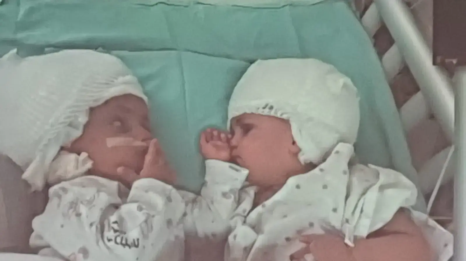 לראשונה בישראל ניתוח ראשון מסוגו ומהנדירים בעולם של הפרדת תאומות המחוברות בראשן נערך בסורוקה לראשונה בישראל ניתוח ראשון מסוגו ומהנדירים בעולם של הפרדת תאומות המחוברות בראשן נערך בסורוקה