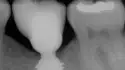 שתלים קצרים שתלים קצרים