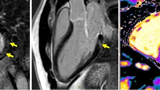 הדמיות MRI של לב שנפגע בצורה קלה לאחר חיסון קורונה הדמיות MRI של לב שנפגע בצורה קלה לאחר חיסון קורונה