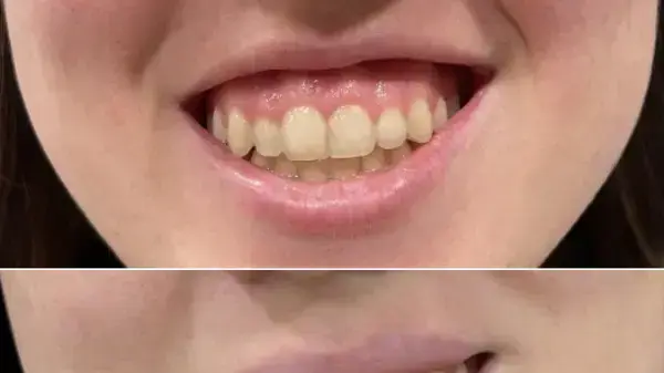 גאמי סמייל - Juvéderm® גאמי סמייל - Juvéderm®