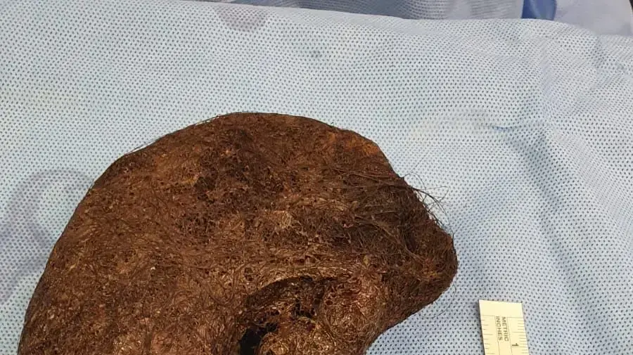 גוש השיער שהוצא מבטנה של נערה בת 13 בבית החולים הדסה גוש השיער שהוצא מבטנה של נערה בת 13 בבית החולים הדסה