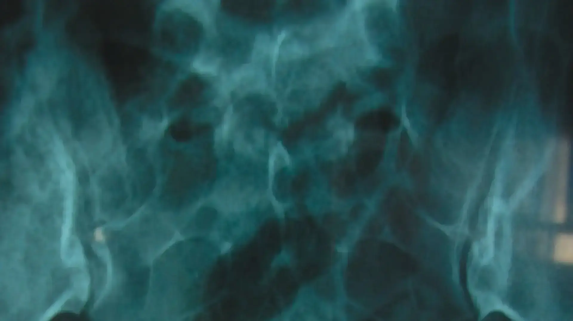 רופאים מצאו כוס זכוכית תקועה בשלפוחית שתן של מטופלת מזה 4 שנים רופאים מצאו כוס זכוכית תקועה בשלפוחית שתן של מטופלת מזה 4 שנים