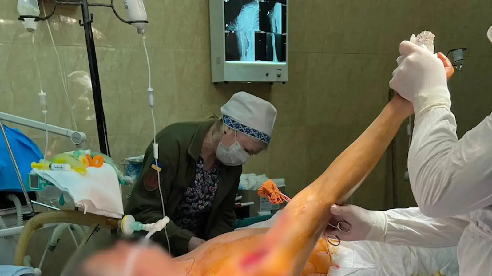 ניתוח "בשלט רחוק" בעזרת רופא מרמב"ם הציל את זרועו של הקצין האוקראיני ניתוח "בשלט רחוק" בעזרת רופא מרמב"ם הציל את זרועו של הקצין האוקראיני