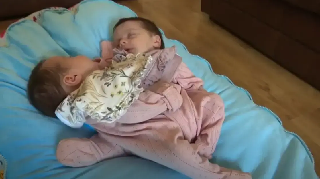 תאומות סיאמיות תאומות סיאמיות