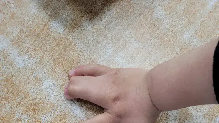 רני זריהן לפני הניתוח