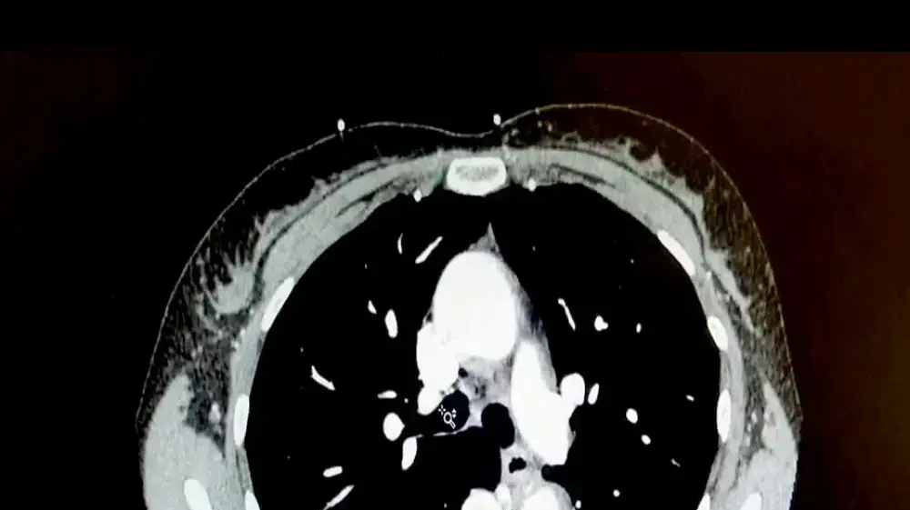 MRI של הלב MRI של הלב