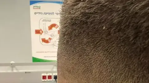 אוזנו של אדם שעבר ניתוח פלסטי בטורקיה שהסתבך אוזנו של אדם שעבר ניתוח פלסטי בטורקיה שהסתבך