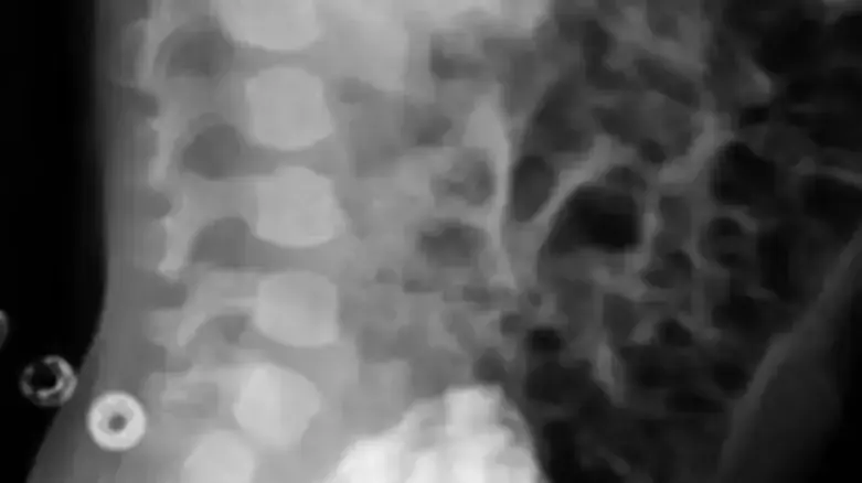 צילום רנטגן של ילד איראני שנולד ללא איבר מין צילום רנטגן של ילד איראני שנולד ללא איבר מין
