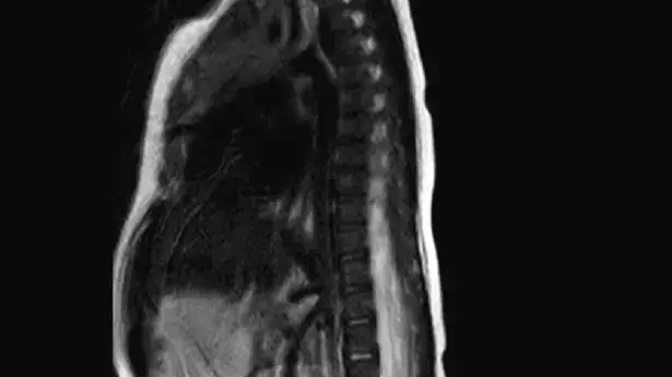 MRI המציג את עמוד השדרה וחוט שדרה שבעלי מאפיינים נורמליים - וזנב אנושי MRI המציג את עמוד השדרה וחוט שדרה שבעלי מאפיינים נורמליים - וזנב אנושי