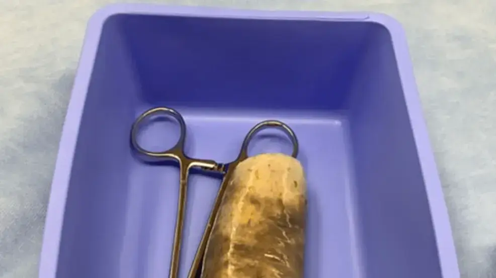 בננה עטופה בקונדום נמצאה תקועה במעי הדק של מטופל בננה עטופה בקונדום נמצאה תקועה במעי הדק של מטופל