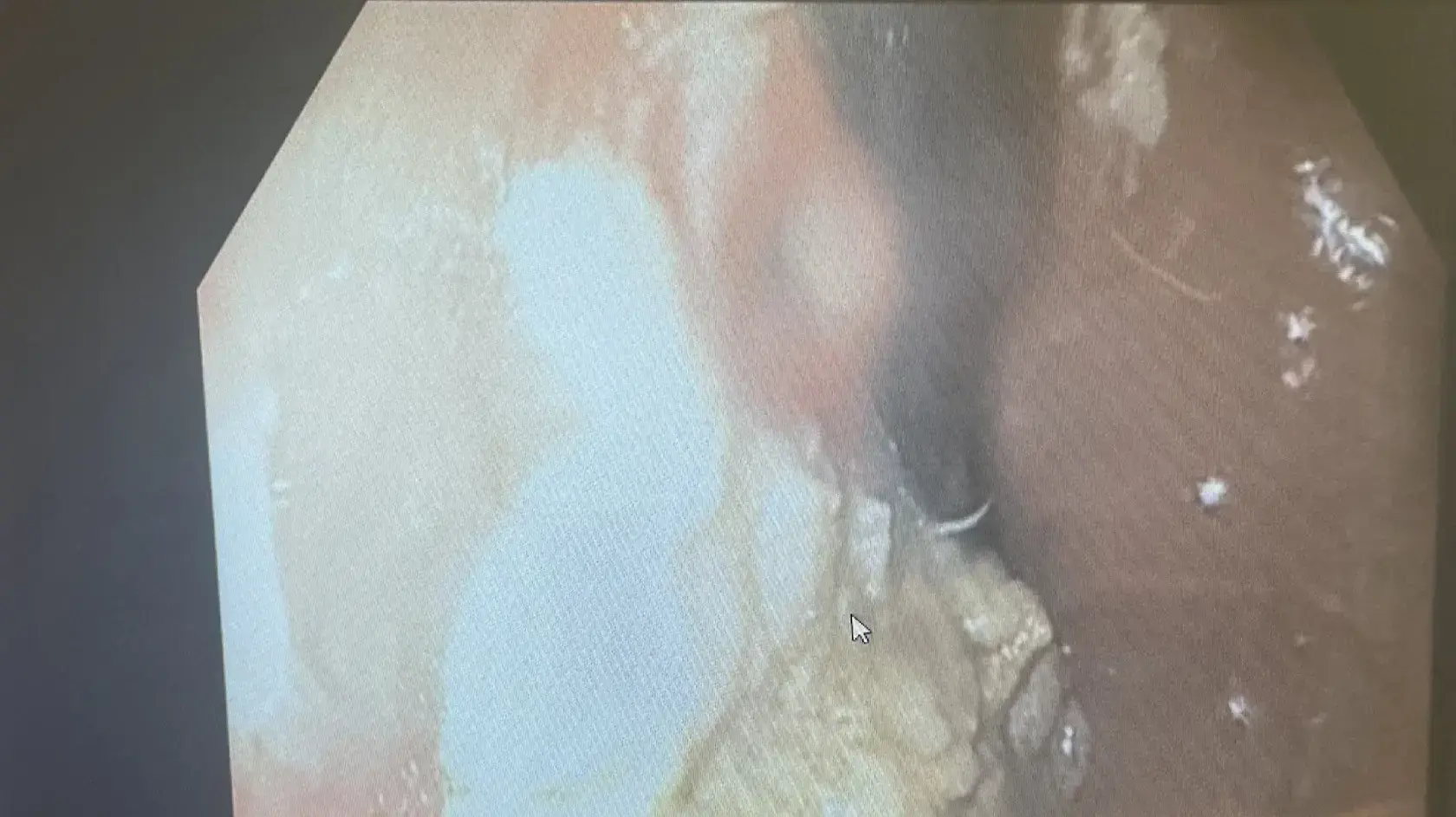 צילום רנטגן של גוש המסטיקים שנמצא בבטנו של בן ה-5 צילום רנטגן של גוש המסטיקים שנמצא בבטנו של בן ה-5