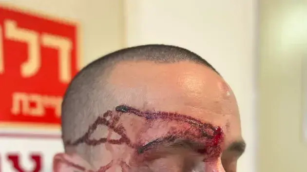 אורי, מפגין שטוען שהותקף על ידי מפקד יס"מ תל אביב, בהפגנות 26 ביולי 2023 אורי, מפגין שטוען שהותקף על ידי מפקד יס"מ תל אביב, בהפגנות 26 ביולי 2023