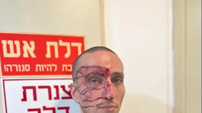 אורי, מפגין שטוען שהותקף על ידי מפקד יס"מ תל אביב, בהפגנות 26 ביולי 2023 אורי, מפגין שטוען שהותקף על ידי מפקד יס"מ תל אביב, בהפגנות 26 ביולי 2023