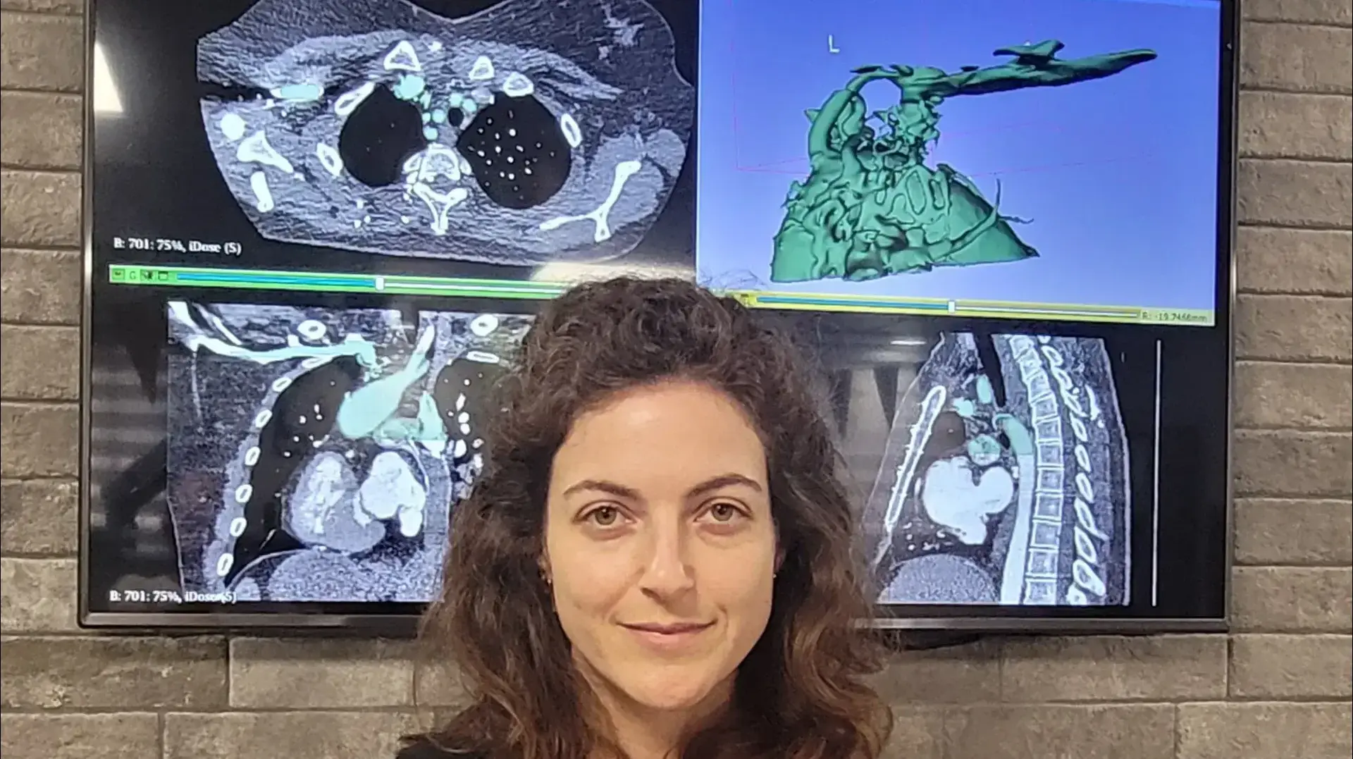 ירדן מור, ראש מערך התלת מימד במערך החדשנות בבילינסון עם הדפס כלי הדם של עדן ירדן מור, ראש מערך התלת מימד במערך החדשנות בבילינסון עם הדפס כלי הדם של עדן