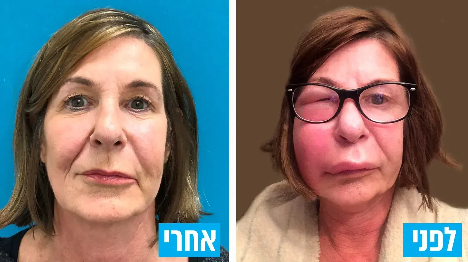 סיבוכים של פעולות קוסמטיות סיבוכים של פעולות קוסמטיות