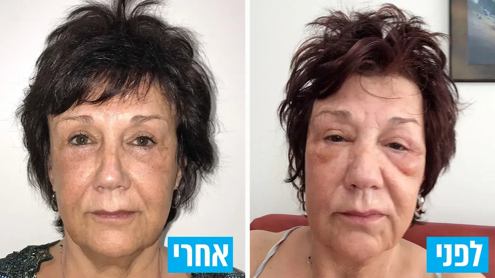 סיבוכים של פעולות קוסמטיות סיבוכים של פעולות קוסמטיות
