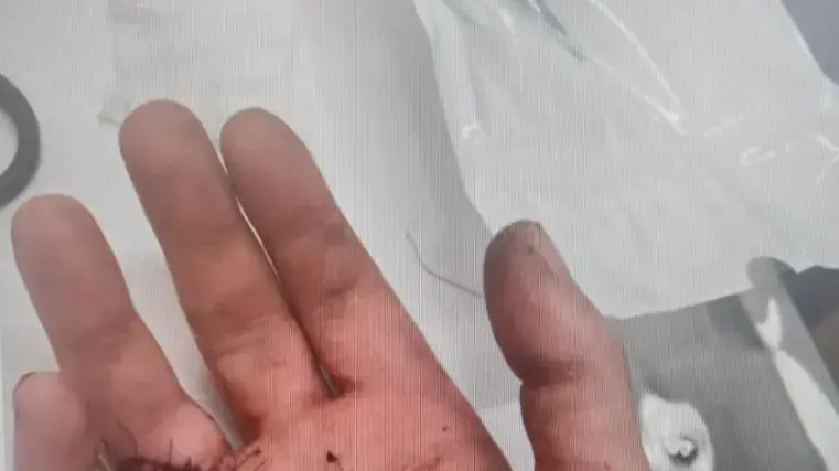 ידו של צעיר בחולון שהותקף בסכין על ידי רוכב קורקינט חשמלי חשוד. 18 בפברואר 2024