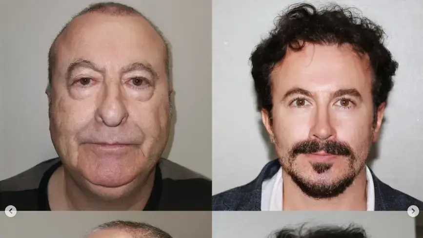 תמונת לפני ואחרי ניתוח פלסטי תמונת לפני ואחרי ניתוח פלסטי