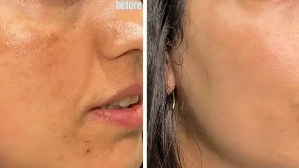 לפני ואחרי שימוש ב-CELLBOOSTER לפני ואחרי שימוש ב-CELLBOOSTER