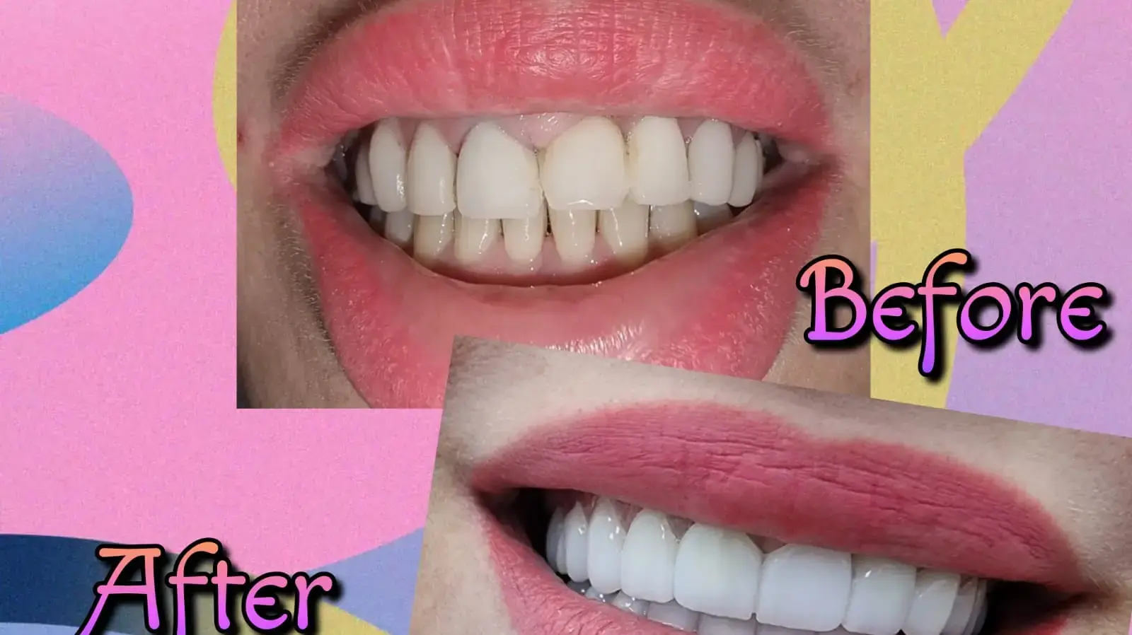 לפני אחרי לפני אחרי