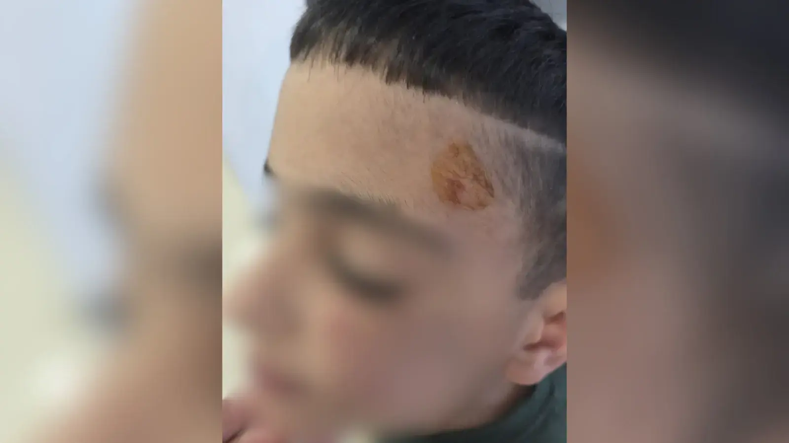 פציעות של ילד מגן יסמין, קרית ביאליק