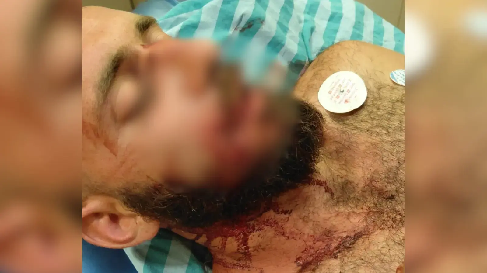 מוחה שנפצע קשה בראשו בעקבות רימוני הלם של שוטרים מוחה שנפצע קשה בראשו בעקבות רימוני הלם של שוטרים
