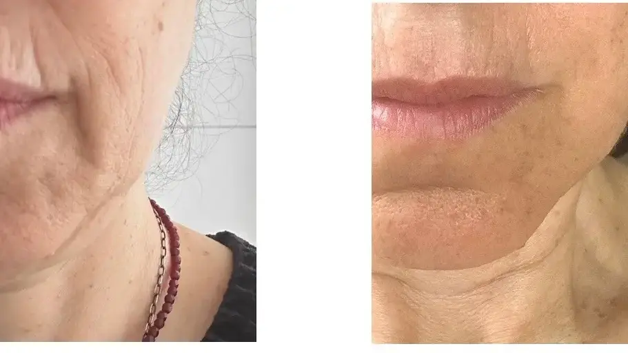 לפני ואחרי מיצוק ללא הזרקות לפני ואחרי מיצוק ללא הזרקות