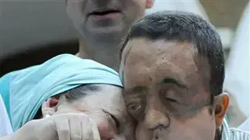 מושתל פנים מספרד נחשף לאחר הניתוח מושתל פנים מספרד נחשף לאחר הניתוח