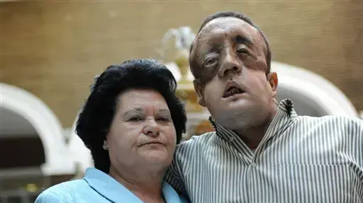 מושתל פנים מספרד נחשף לאחר הניתוח מושתל פנים מספרד נחשף לאחר הניתוח