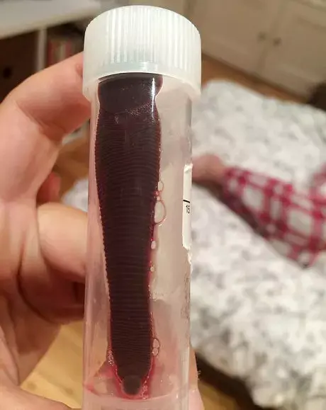 חזרה מהמזרח עם עלוקה באורך 7 ס"מ באף