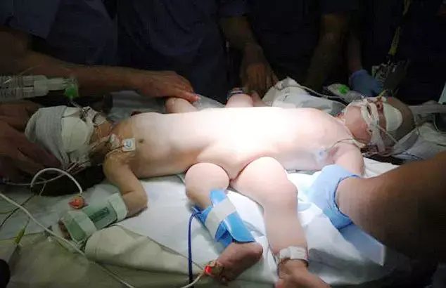 בשבוע אחד: שני זוגות תאומים סיאמיים הופרדו בהצלחה