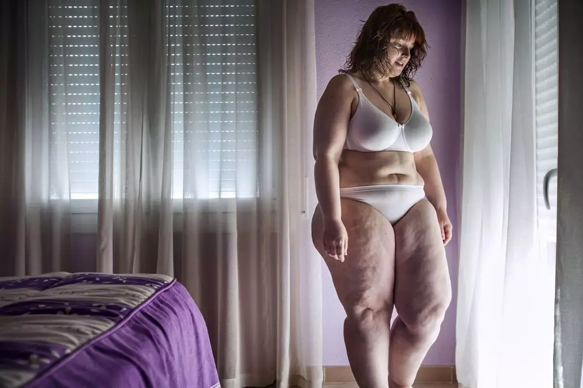 צפו: מאחורי הקלעים של ניתוחי קיצורי הקיבה