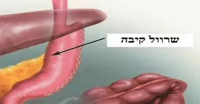 טיפול חדש בהשמנת יתר: שרוול קיבה