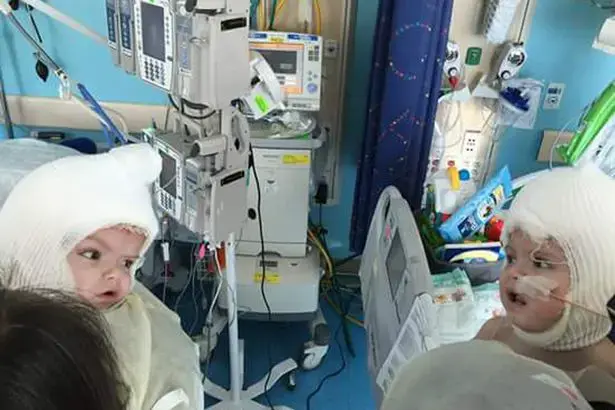 פנים אל מול פנים: תאומים שהיו מחוברים בראשם רואים זה את זה לראשונה