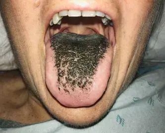 מה גרם ללשון של האישה הזאת להפוך שחורה ושעירה?