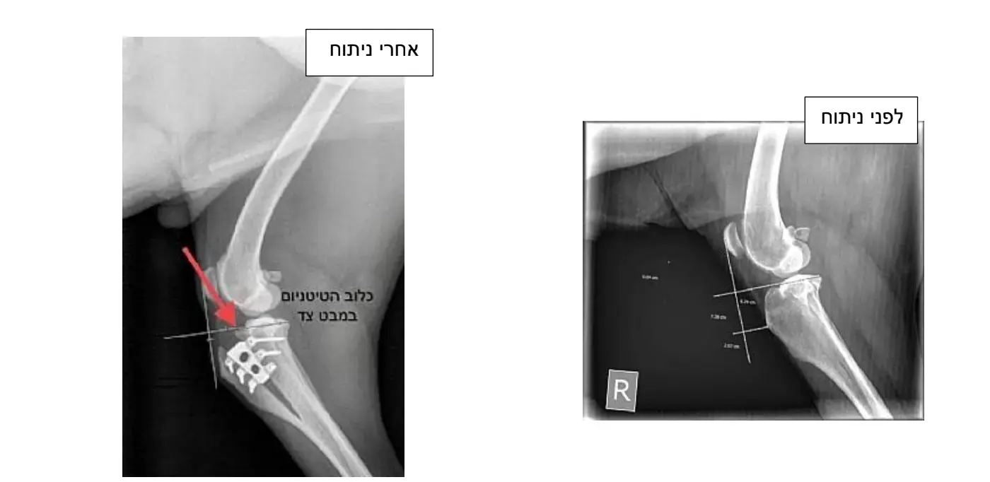 לראשונה בישראל: ניתוח חדשני להפחתת הסיכון לקרע חוזר ברצועה הצולבת
