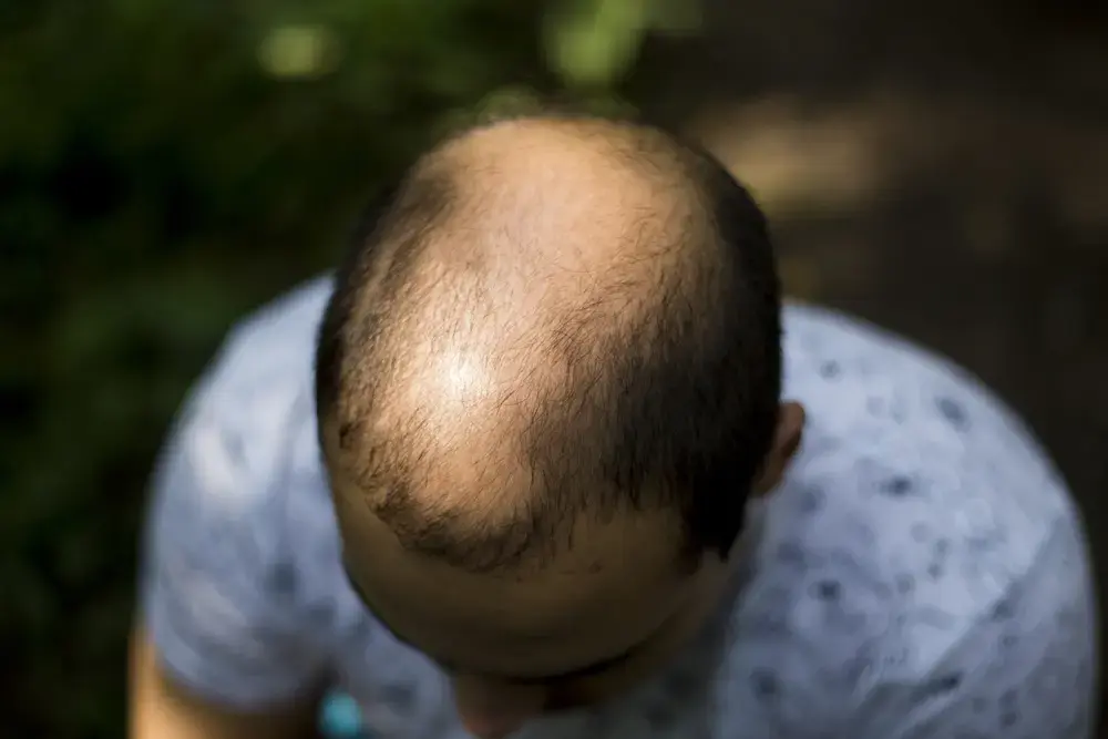 גברים, אל תעבדו קשה כל כך. אתם עלולים להקריח מזה