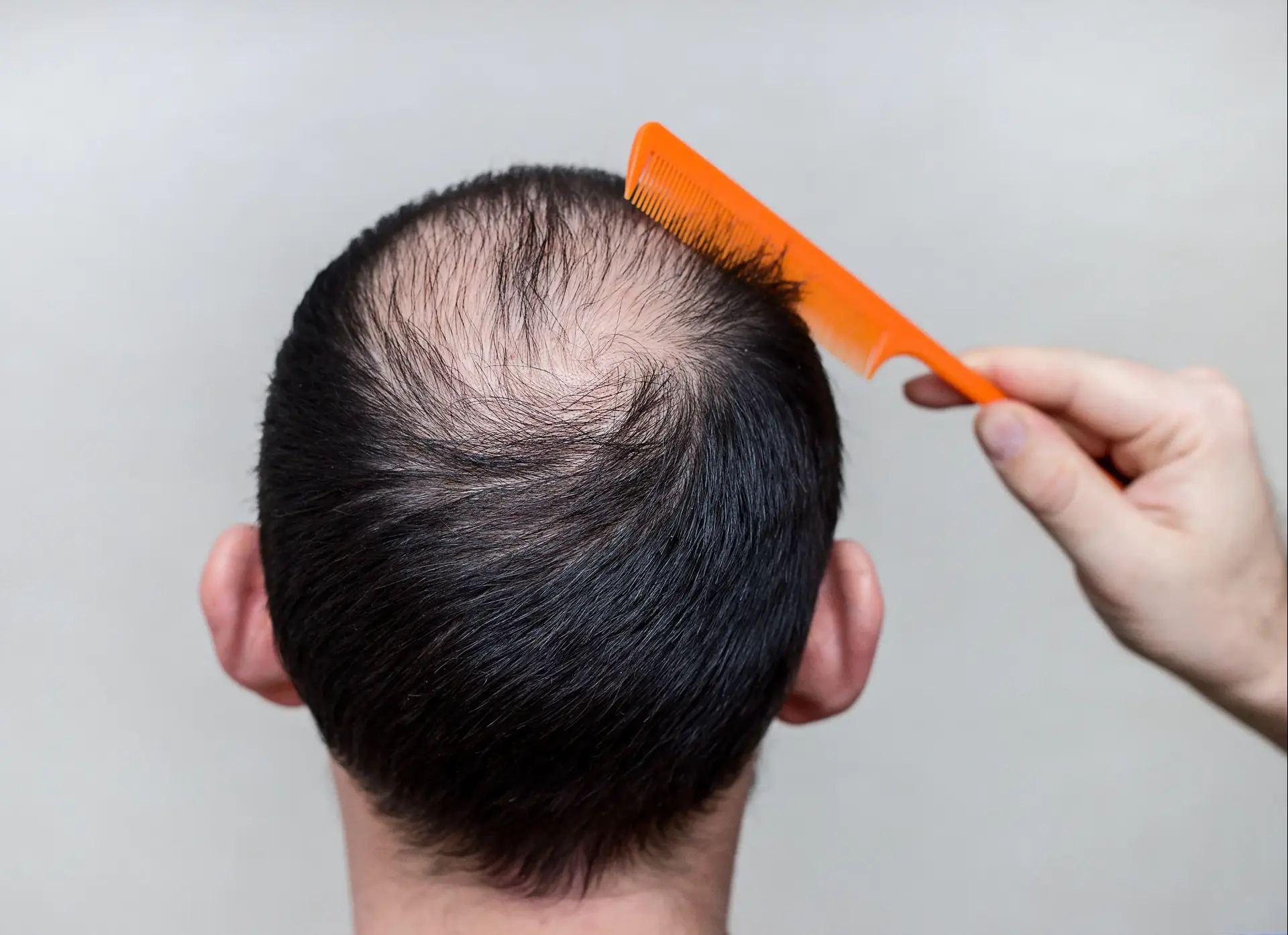 יש טיפול אחד נגד התקרחות שעובד יותר טוב מכל השאר