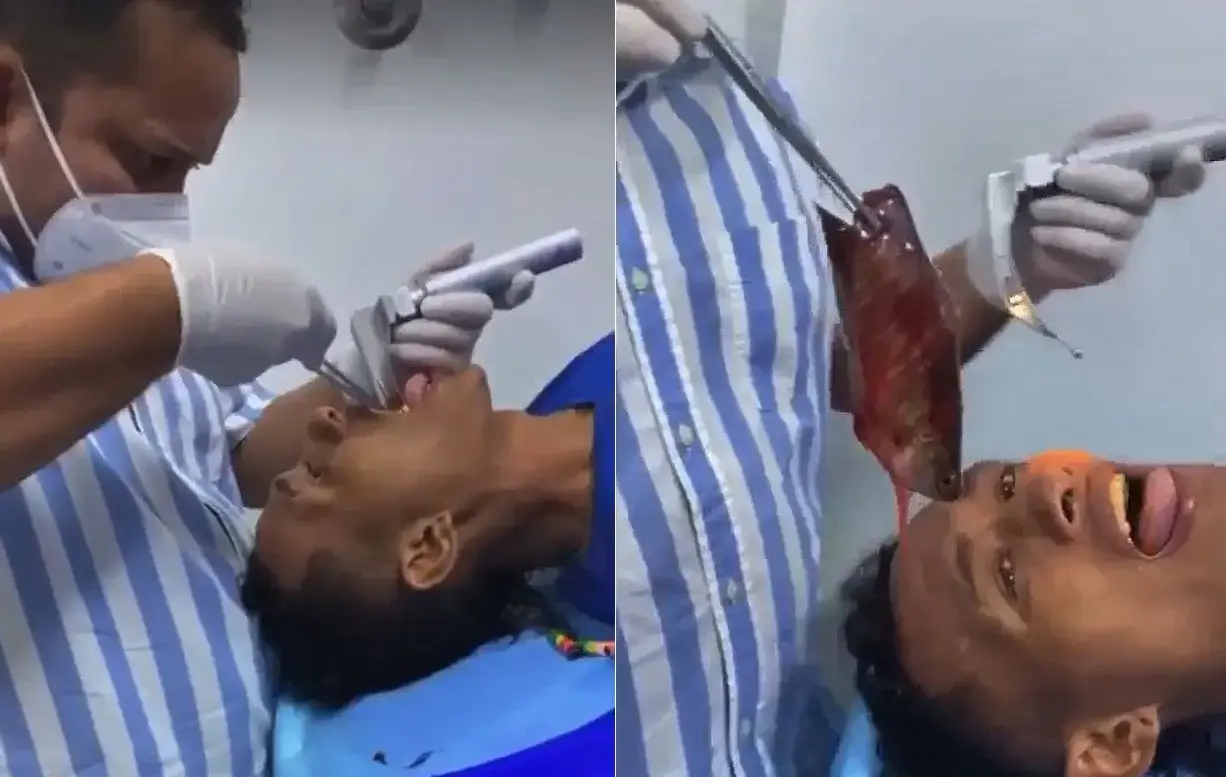 קשה לצפייה: דג חי באורך 18 ס"מ נשלף מגרונו של דייג עקב טעות קריטית שעשה