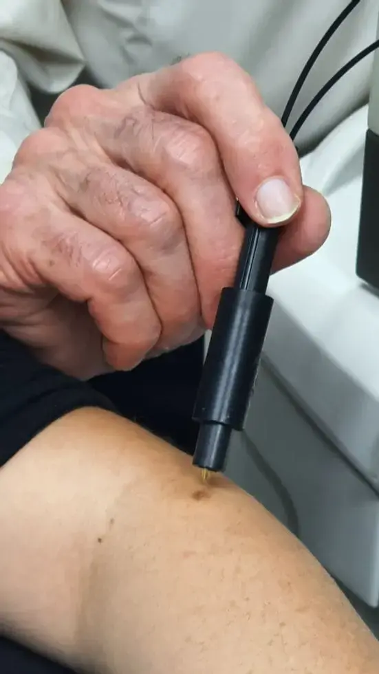 חוקר ישראלי מצא דרך לאבחן מלנומה תוך רגע