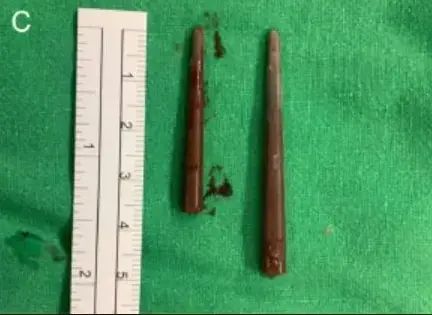 ריב בין אחיות הסתיים בצ'ופסטיקס תקוע באף